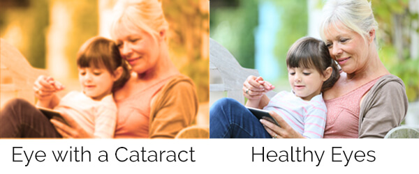 Vision with and without Cataracts
