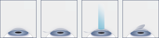 LASIK Eye Surgery Procedure Diagram