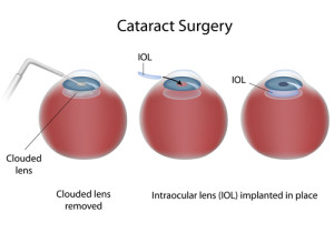 Cataract Surgery Diagram