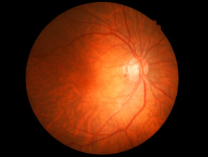 Eye Fundus Photo